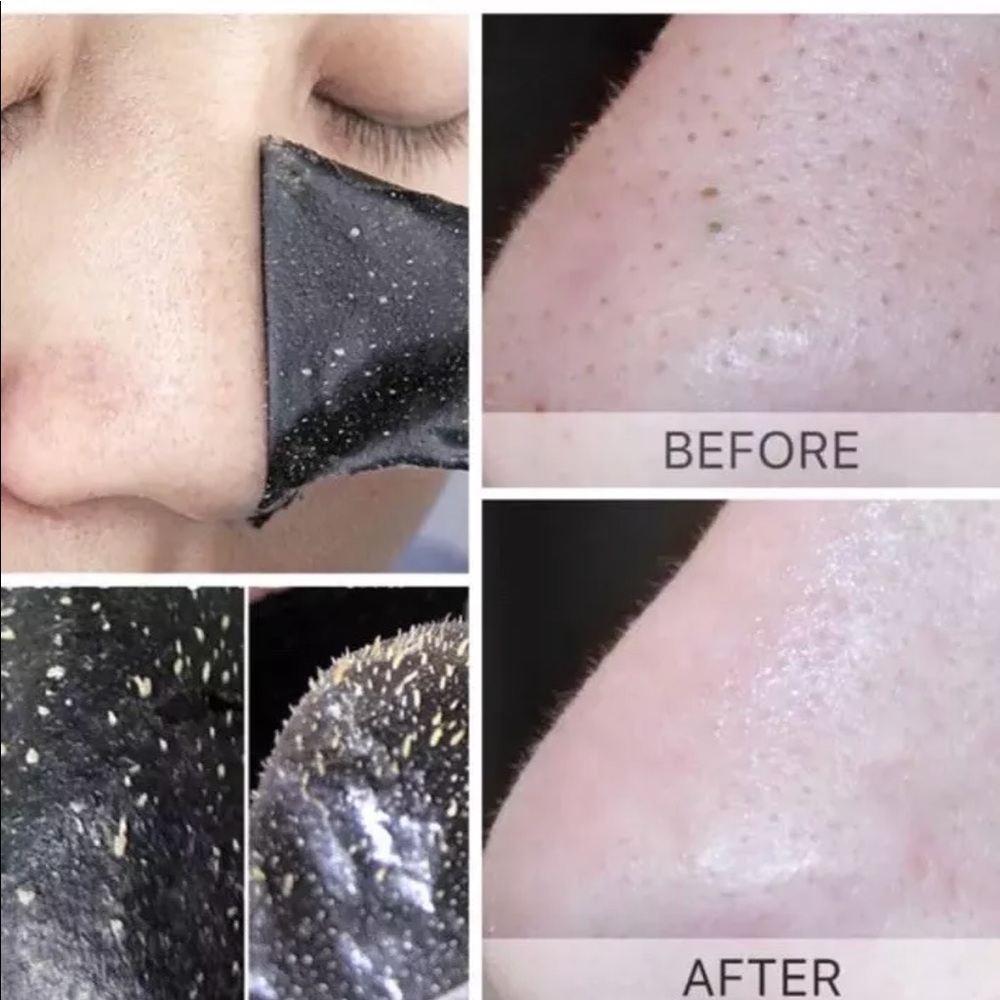 Best Blackheads remover strips (10 pieces)